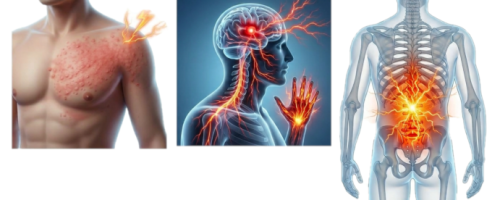 douleur neuropathique
